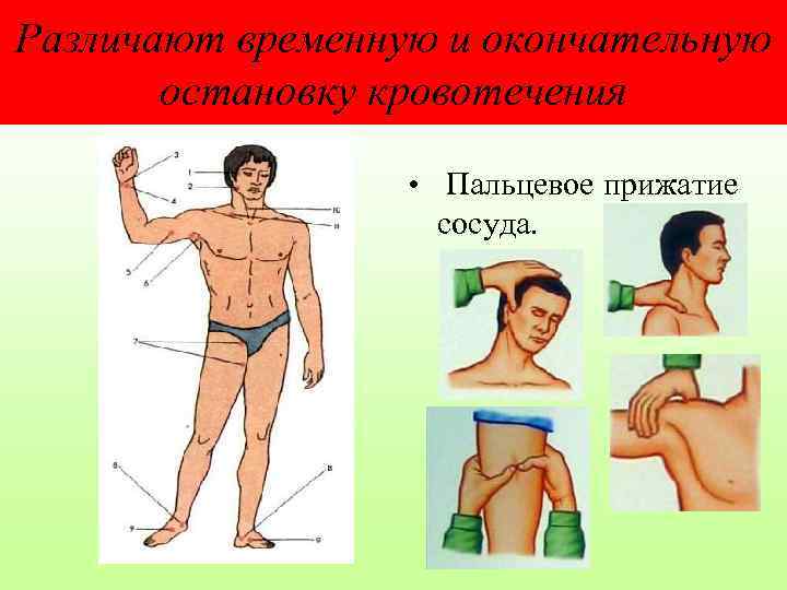 Различают временную и окончательную остановку кровотечения • Пальцевое прижатие сосуда. 