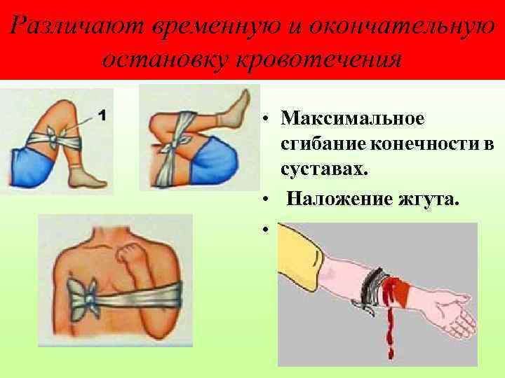 Различают временную и окончательную остановку кровотечения • Максимальное сгибание конечности в суставах. • Наложение