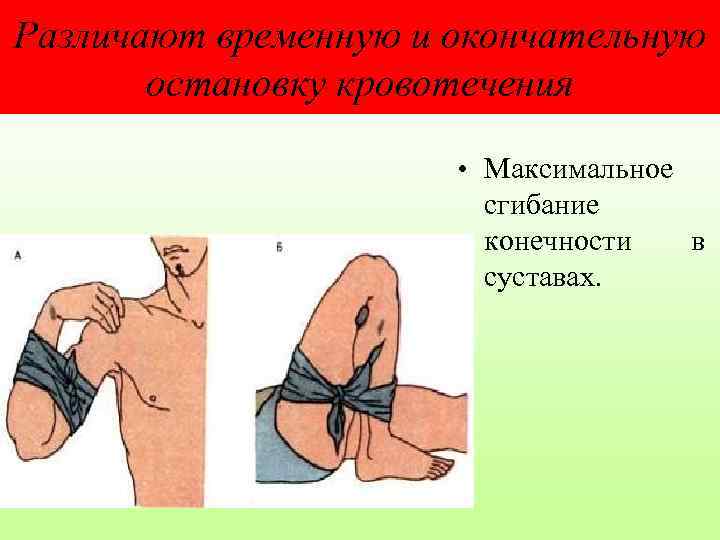 Различают временную и окончательную остановку кровотечения • Максимальное сгибание конечности в суставах. 