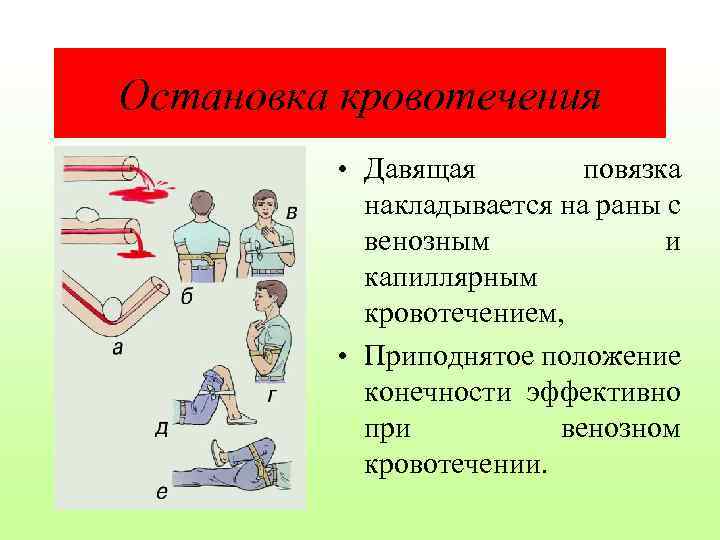 Остановка кровотечения • Давящая повязка накладывается на раны с венозным и капиллярным кровотечением, •