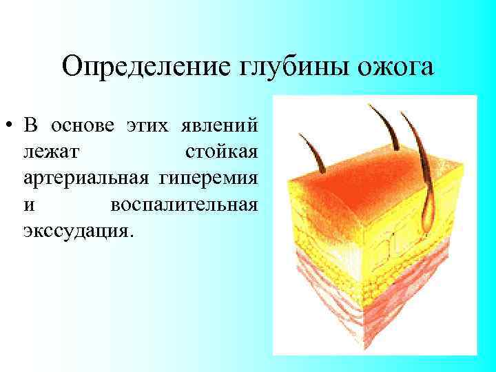 Определение глубины ожога • В основе этих явлений лежат стойкая артериальная гиперемия и воспалительная