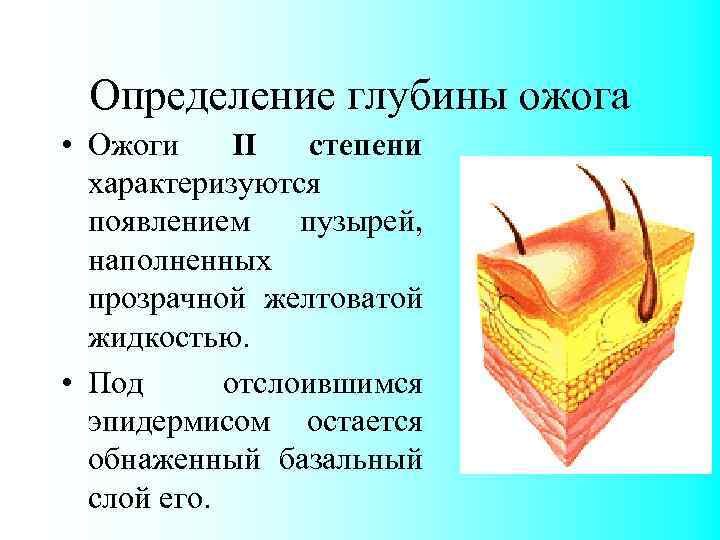 Определение глубины ожога • Ожоги II степени характеризуются появлением пузырей, наполненных прозрачной желтоватой жидкостью.