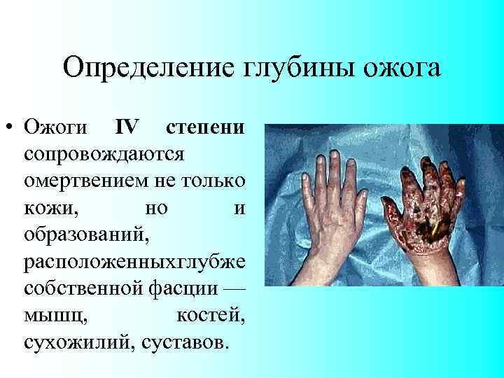 Определение глубины ожога • Ожоги IV степени сопровождаются омертвением не только кожи, но и