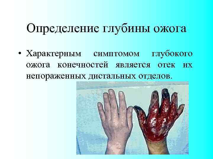 Определение глубины ожога • Характерным симптомом глубокого ожога конечностей является отек их непораженных дистальных