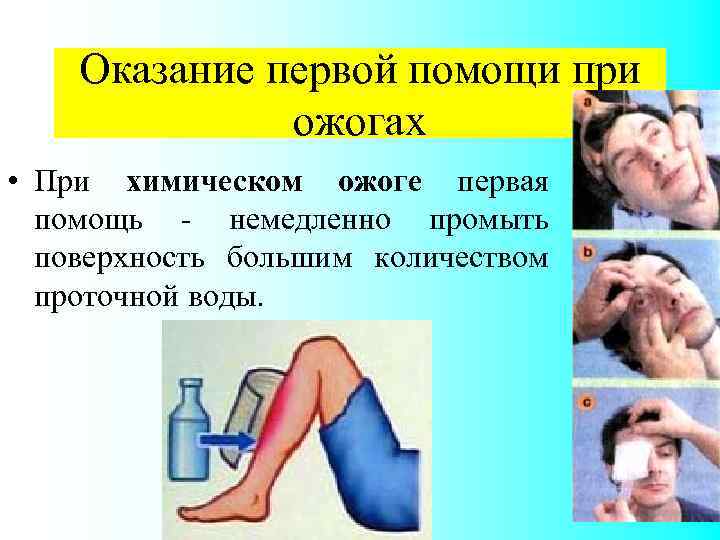 Оказание первой помощи при ожогах • При химическом ожоге первая помощь - немедленно промыть