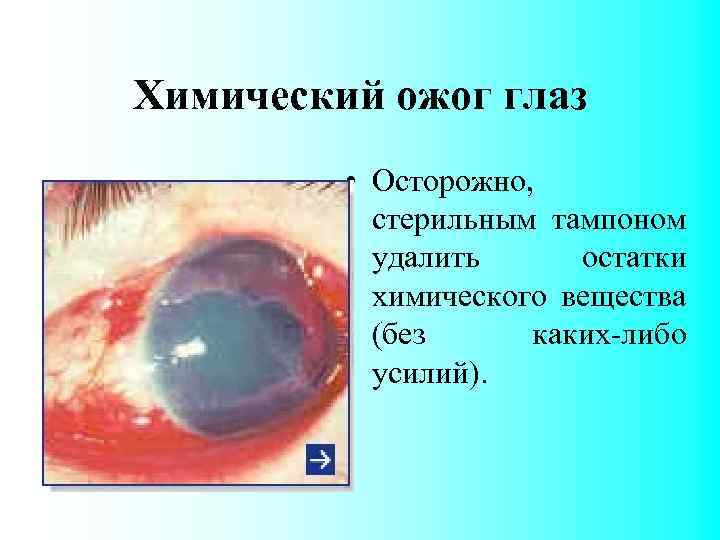 Химический ожог глаз • Осторожно, стерильным тампоном удалить остатки химического вещества (без каких-либо усилий).