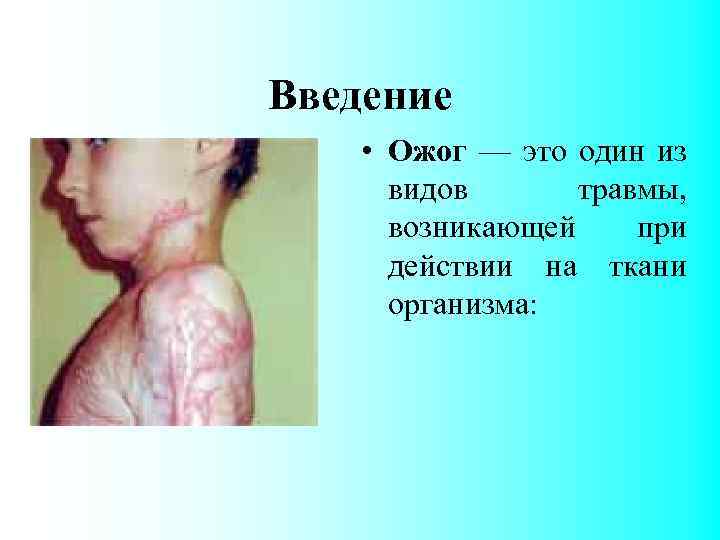 Введение • Ожог — это один из видов травмы, возникающей при действии на ткани