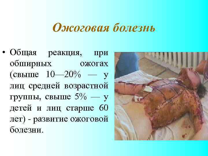 Ожоговая болезнь • Общая реакция, при обширных ожогах (свыше 10— 20% — у лиц