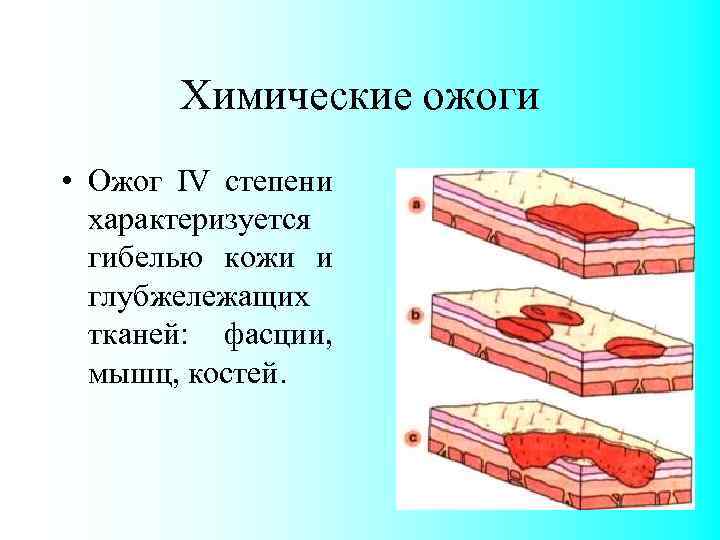 Химические ожоги • Ожог IV степени характеризуется гибелью кожи и глубжележащих тканей: фасции, мышц,