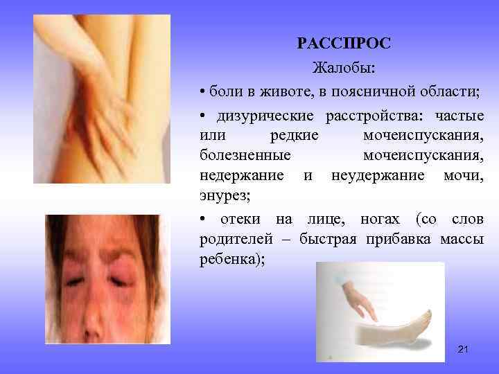 РАССПРОС Жалобы: • боли в животе, в поясничной области; • дизурические расстройства: частые или