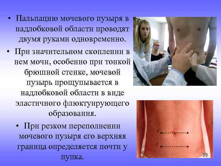 • Пальпацию мочевого пузыря в надлобковой области проводят двумя руками одновременно. • При