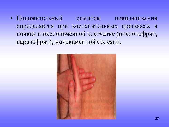  • Положительный симптом поколачивания определяется при воспалительных процессах в почках и околопочечной клетчатке