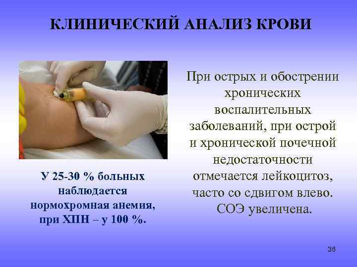 КЛИНИЧЕСКИЙ АНАЛИЗ КРОВИ У 25 -30 % больных наблюдается нормохромная анемия, при ХПН –