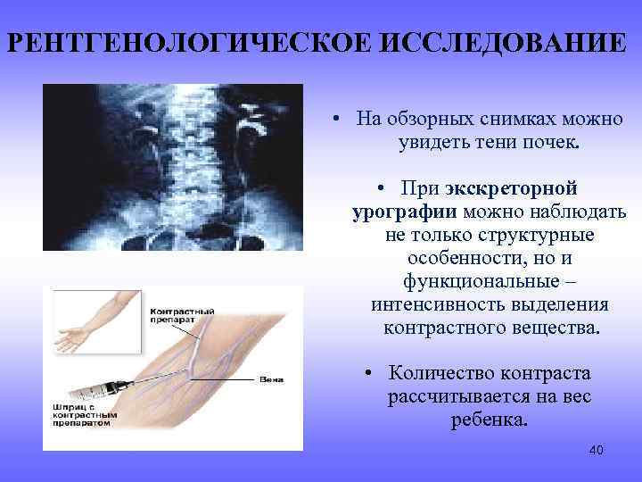 РЕНТГЕНОЛОГИЧЕСКОЕ ИССЛЕДОВАНИЕ • На обзорных снимках можно увидеть тени почек. • При экскреторной урографии