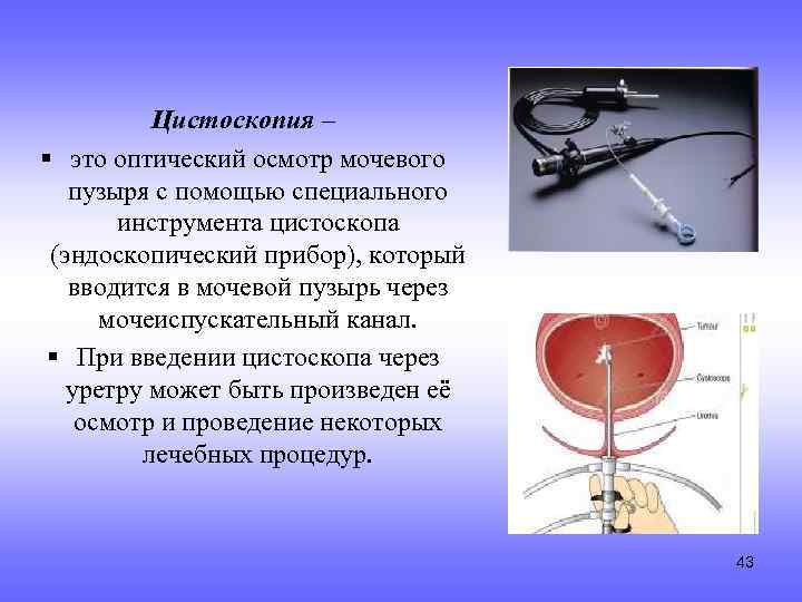 Цистоскопия – § это оптический осмотр мочевого пузыря с помощью специального инструмента цистоскопа (эндоскопический