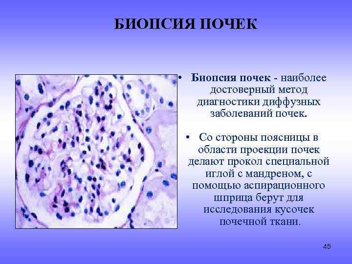 БИОПСИЯ ПОЧЕК • Биопсия почек - наиболее достоверный метод диагностики диффузных заболеваний почек. •
