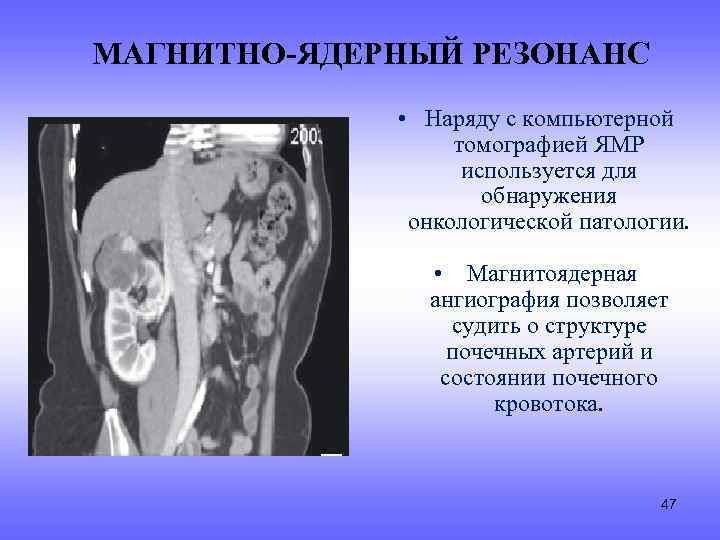 МАГНИТНО-ЯДЕРНЫЙ РЕЗОНАНС • Наряду с компьютерной томографией ЯМР используется для обнаружения онкологической патологии. •
