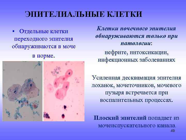 ЭПИТЕЛИАЛЬНЫЕ КЛЕТКИ • Отдельные клетки переходного эпителия обнаруживаются в моче в норме. Клетки почечного