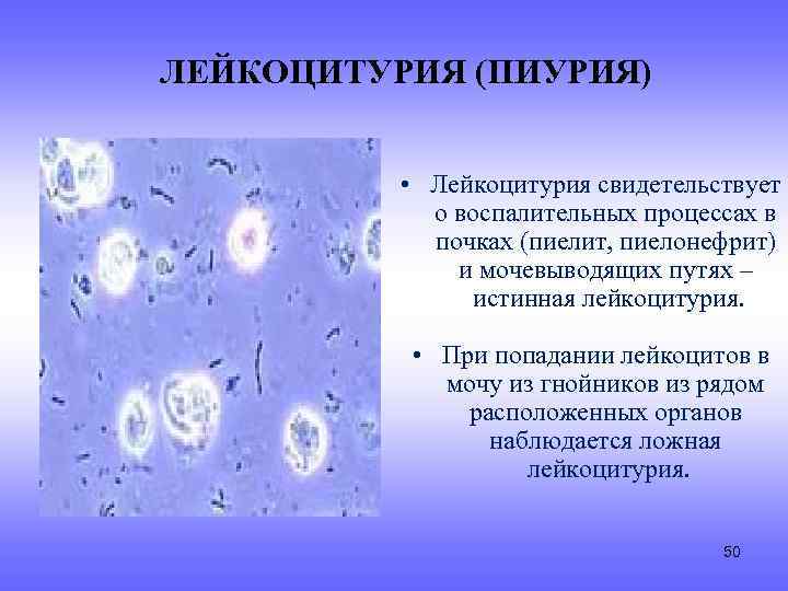 ЛЕЙКОЦИТУРИЯ (ПИУРИЯ) • Лейкоцитурия свидетельствует о воспалительных процессах в почках (пиелит, пиелонефрит) и мочевыводящих