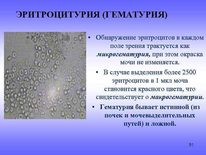 ЭРИТРОЦИТУРИЯ (ГЕМАТУРИЯ) • Обнаружение эритроцитов в каждом поле зрения трактуется как микрогематурия, при этом