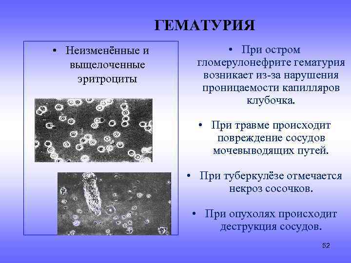 ГЕМАТУРИЯ • Неизменённые и выщелоченные эритроциты • При остром гломерулонефрите гематурия возникает из-за нарушения