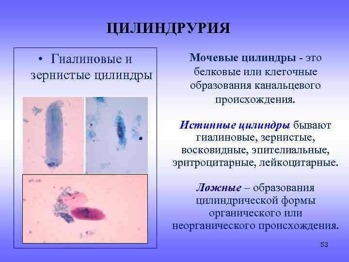 ЦИЛИНДРУРИЯ • Гиалиновые и зернистые цилиндры Мочевые цилиндры - это белковые или клеточные образования