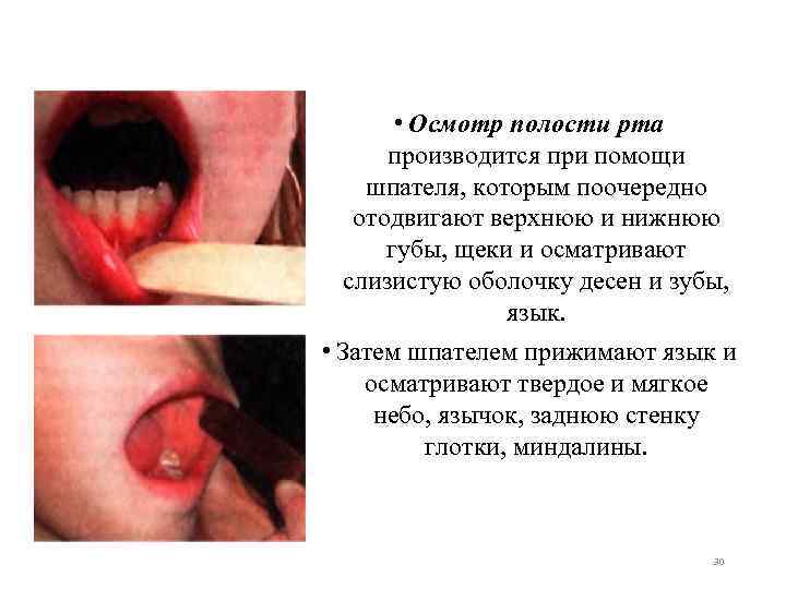  • Осмотр полости рта производится при помощи шпателя, которым поочередно отодвигают верхнюю и