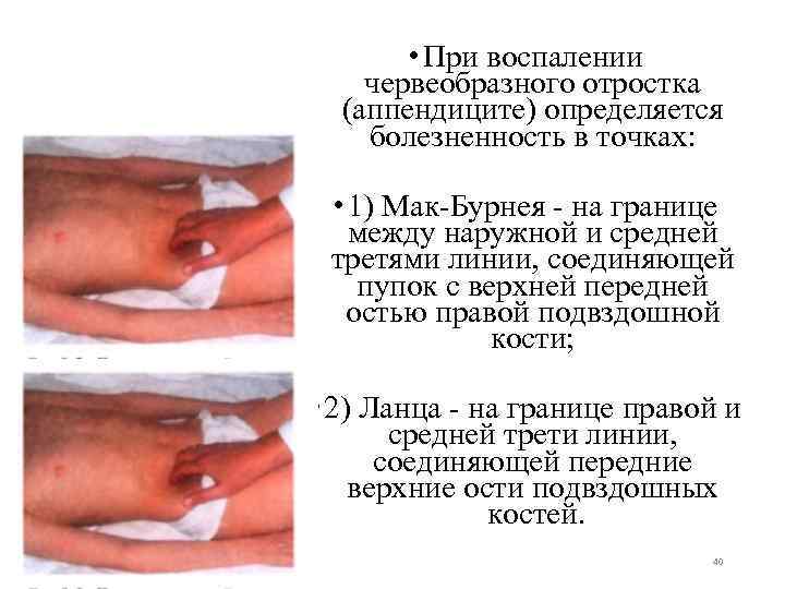  • При воспалении червеобразного отростка (аппендиците) определяется болезненность в точках: • 1) Мак-Бурнея