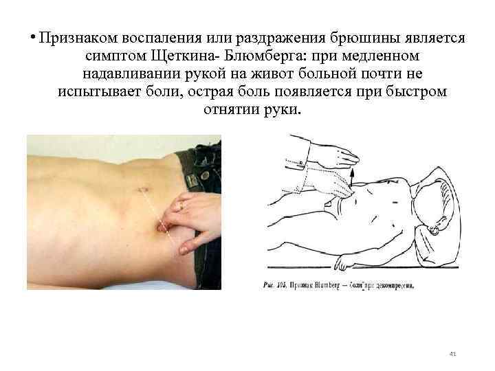  • Признаком воспаления или раздражения брюшины является симптом Щеткина- Блюмберга: при медленном надавливании