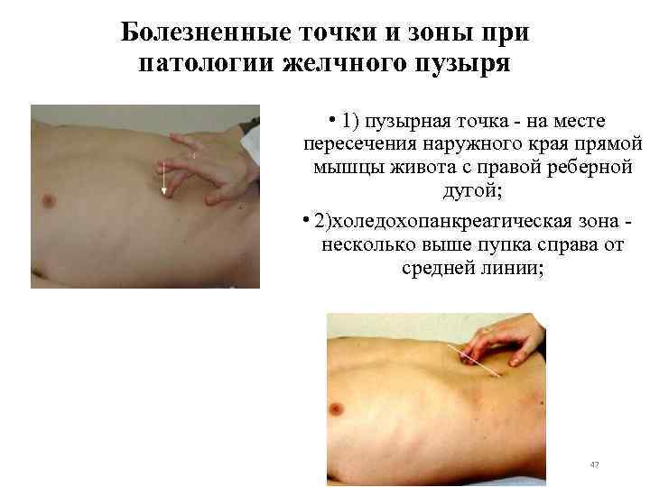Болезненные точки и зоны при патологии желчного пузыря • 1) пузырная точка - на