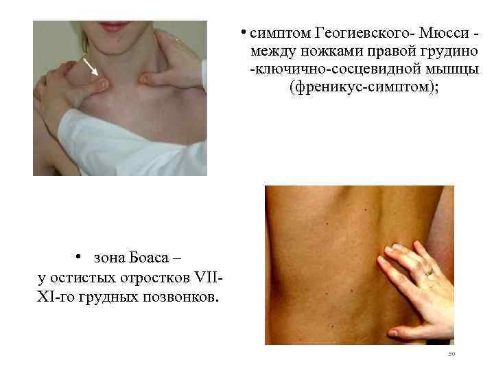  • симптом Геогиевского- Мюсси - между ножками правой грудино -ключично-сосцевидной мышцы (френикус-симптом); •