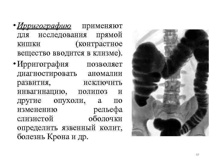  • Ирригографию применяют для исследования прямой кишки (контрастное вещество вводится в клизме). •