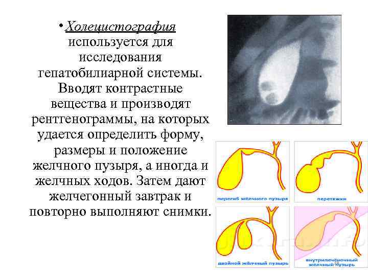  • Холецистография используется для исследования гепатобилиарной системы. Вводят контрастные вещества и производят рентгенограммы,