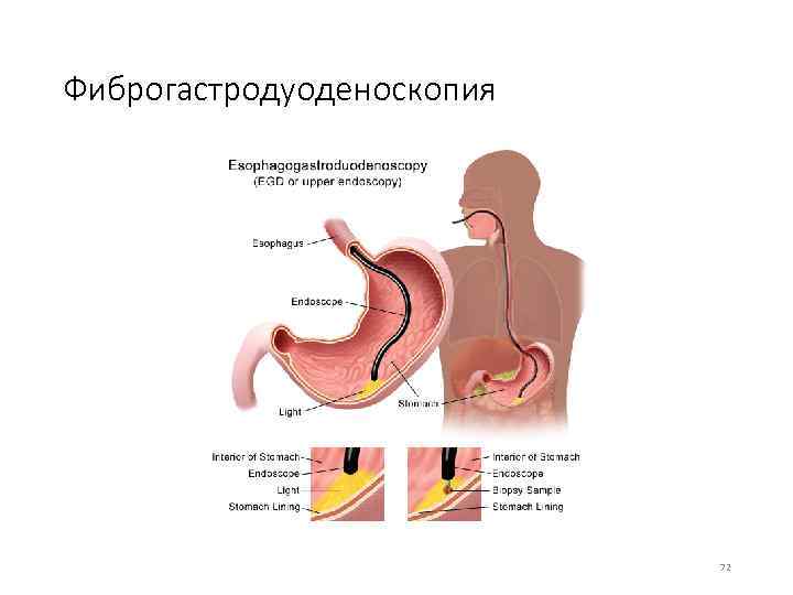 Фиброгастродуоденоскопия 72 