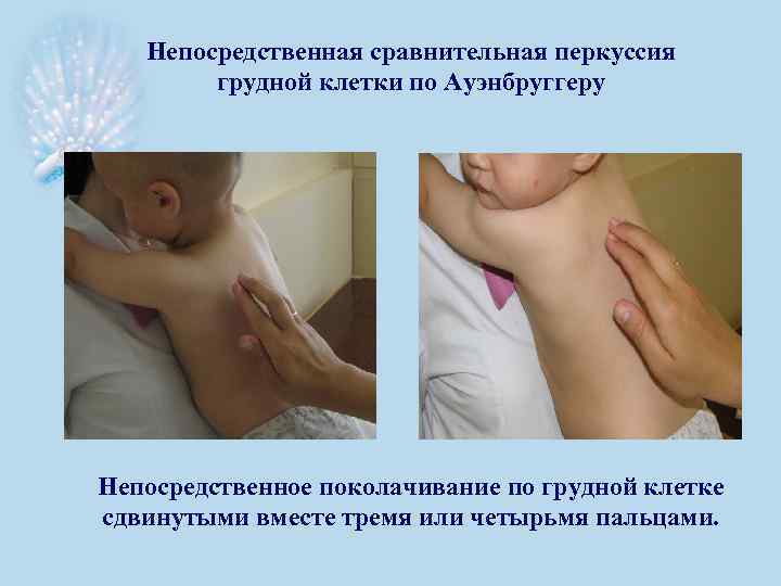 Непосредственная сравнительная перкуссия грудной клетки по Ауэнбруггеру Непосредственное поколачивание по грудной клетке сдвинутыми вместе