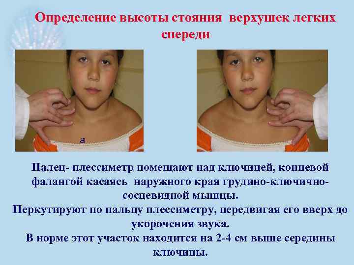 Определение высоты стояния верхушек легких спереди а Палец- плессиметр помещают над ключицей, концевой фалангой