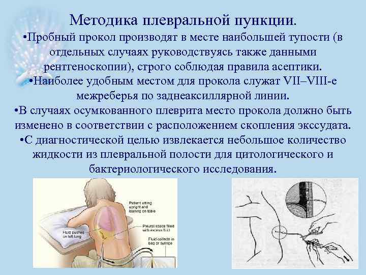 Методика плевральной пункции. • Пробный прокол производят в месте наибольшей тупости (в отдельных случаях
