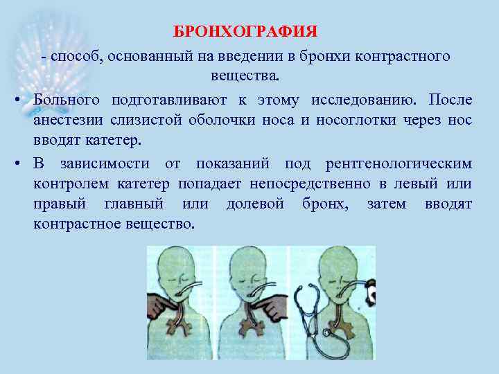 БРОНХОГРАФИЯ - способ, основанный на введении в бронхи контрастного вещества. • Больного подготавливают к