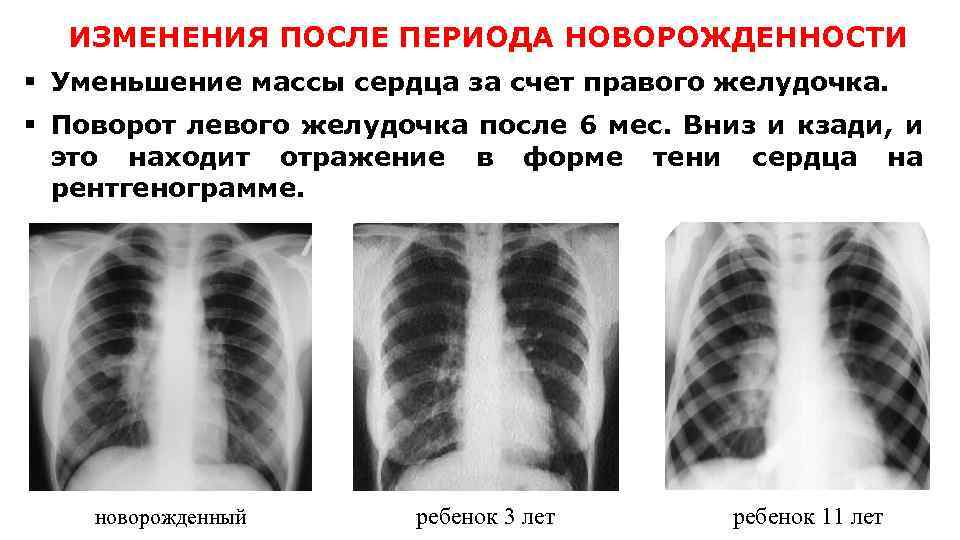 ИЗМЕНЕНИЯ ПОСЛЕ ПЕРИОДА НОВОРОЖДЕННОСТИ § Уменьшение массы сердца за счет правого желудочка. § Поворот