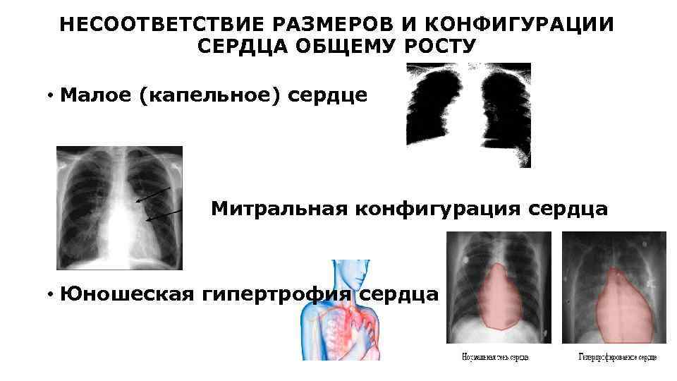 НЕСООТВЕТСТВИЕ РАЗМЕРОВ И КОНФИГУРАЦИИ СЕРДЦА ОБЩЕМУ РОСТУ • Малое (капельное) сердце • Митральная конфигурация