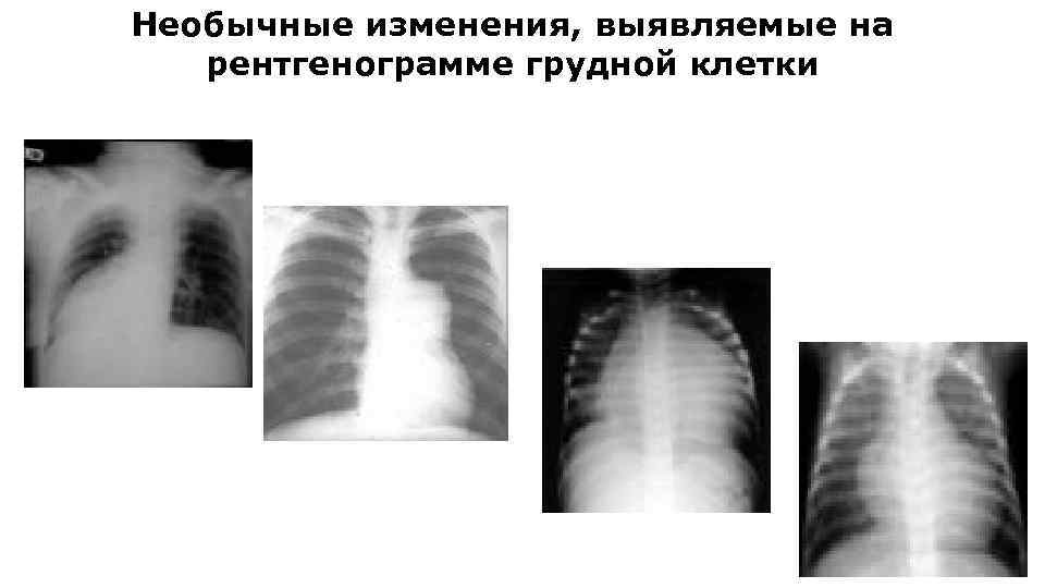 Необычные изменения, выявляемые на рентгенограмме грудной клетки 