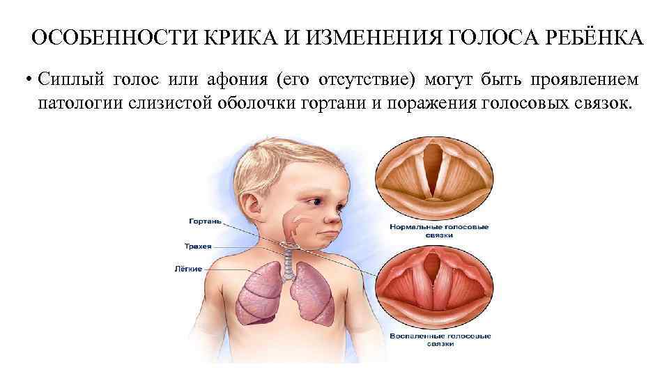 ОСОБЕННОСТИ КРИКА И ИЗМЕНЕНИЯ ГОЛОСА РЕБЁНКА • Сиплый голос или афония (его отсутствие) могут