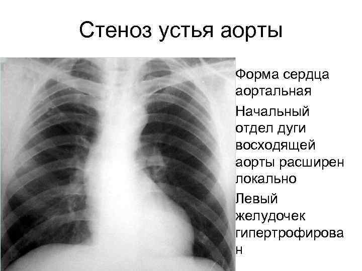 Стеноз устья аорты • Форма сердца аортальная • Начальный отдел дуги восходящей аорты расширен