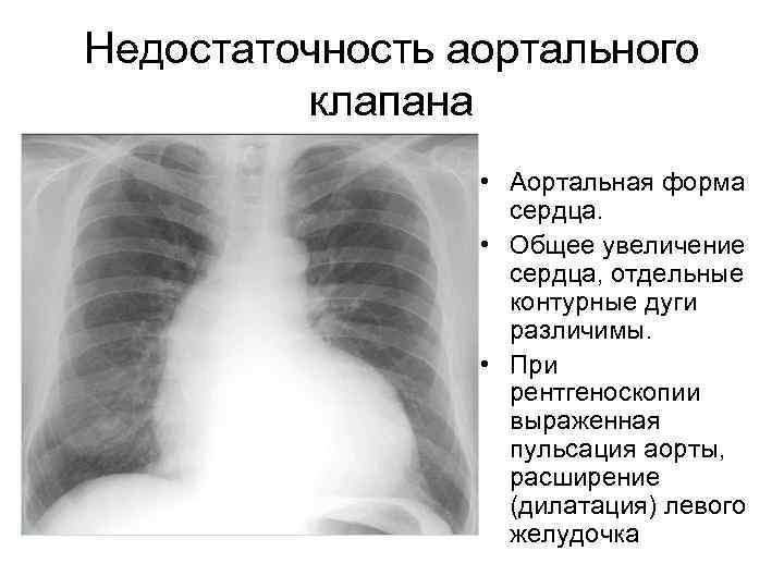 Недостаточность аортального клапана • Аортальная форма сердца. • Общее увеличение сердца, отдельные контурные дуги