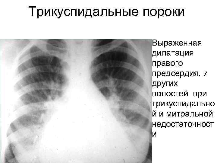 Трикуспидальные пороки • Выраженная дилатация правого предсердия, и других полостей при трикуспидально й и
