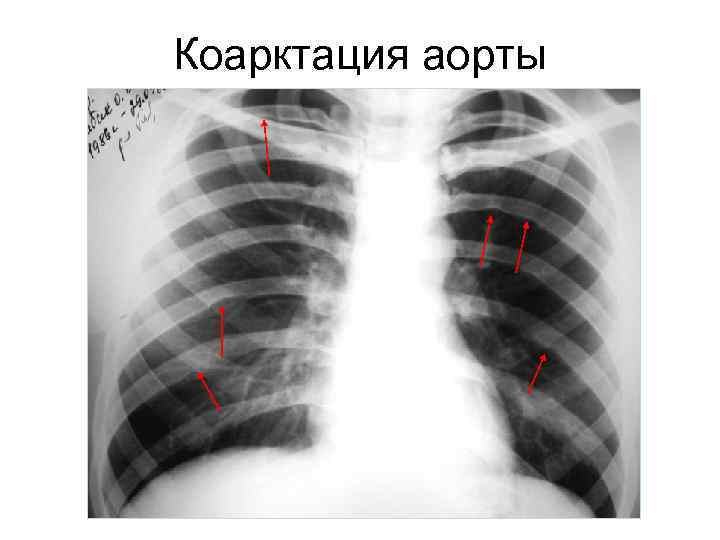 Коарктация аорты 