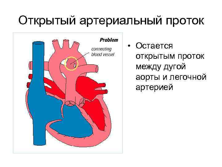 Открытый артериальный проток • Остается открытым проток между дугой аорты и легочной артерией 