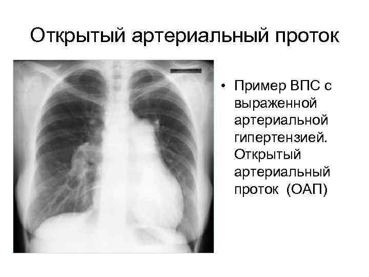 Открытый артериальный проток • Пример ВПС с выраженной артериальной гипертензией. Открытый артериальный проток (ОАП)