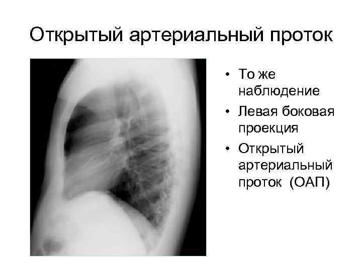 Открытый артериальный проток • То же наблюдение • Левая боковая проекция • Открытый артериальный