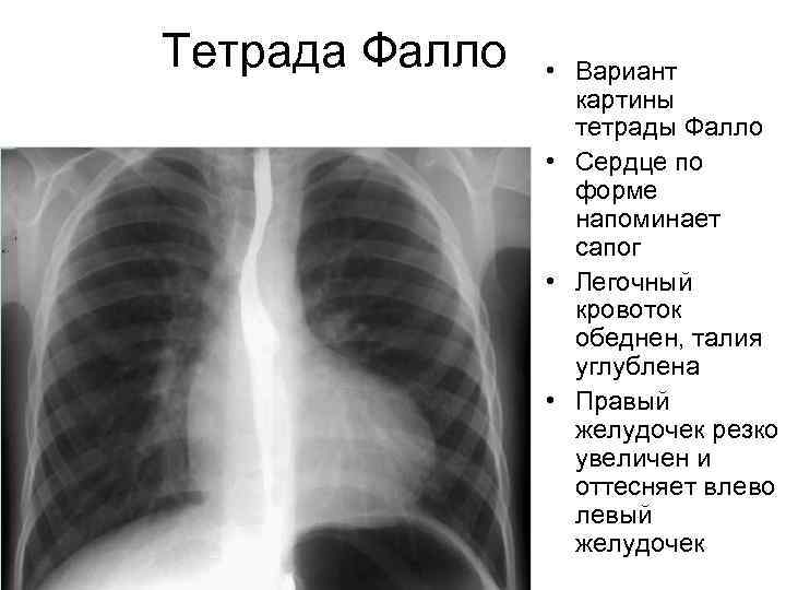 Тетрада Фалло • Вариант картины тетрады Фалло • Сердце по форме напоминает сапог •